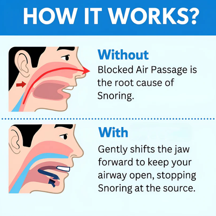 Zentrio® Anti Snoring Mouthpiece